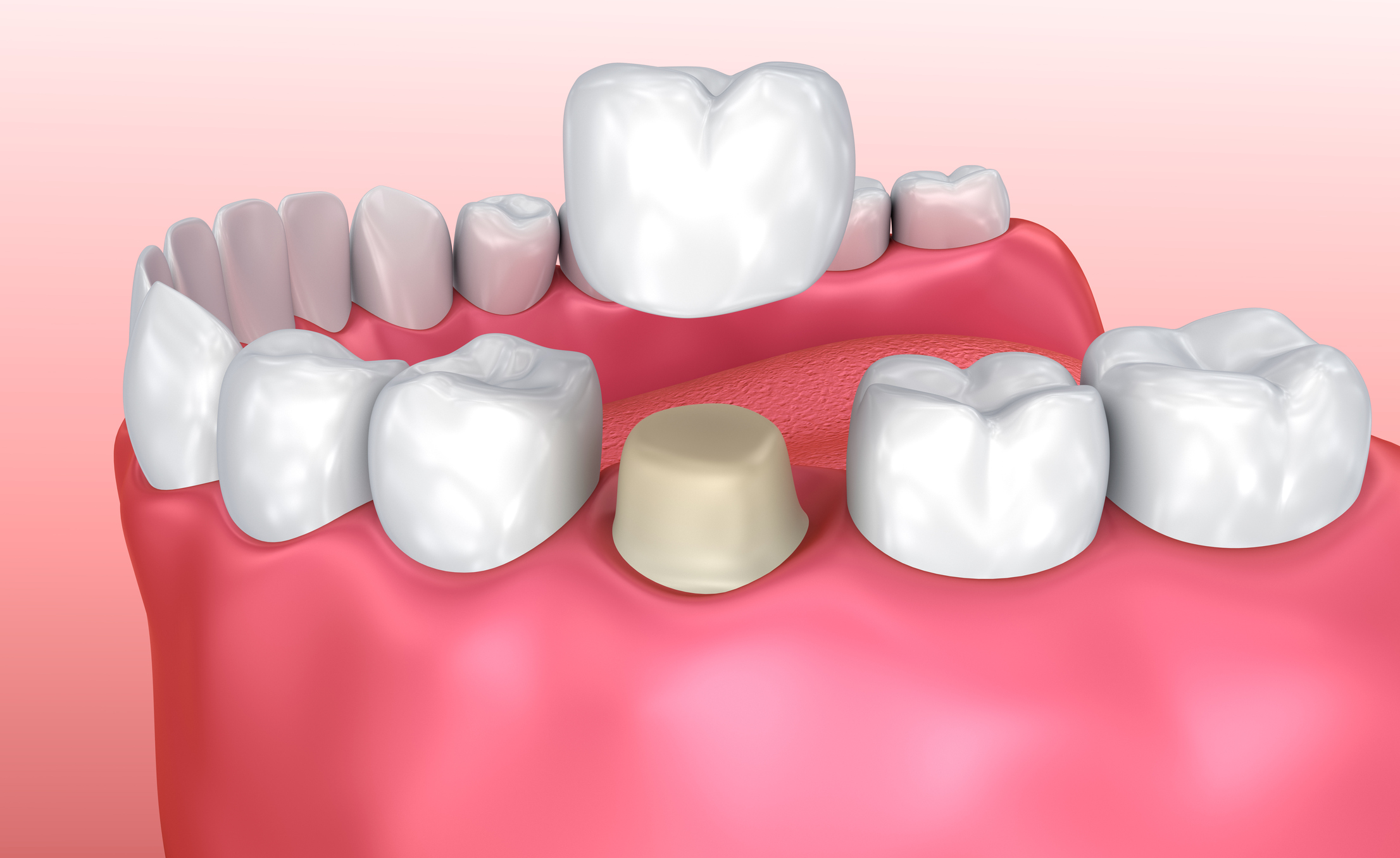 A dental crown being placed over a prepared tooth