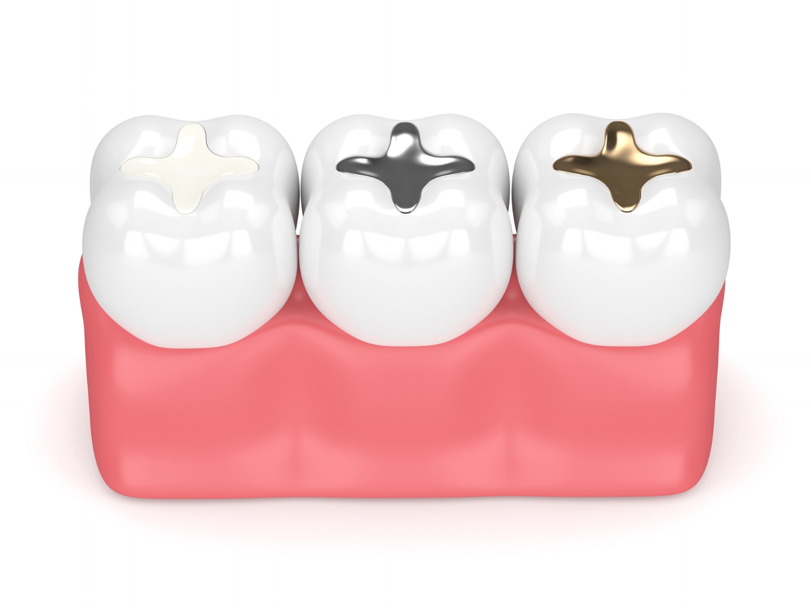 Tooth-colored composite filling material