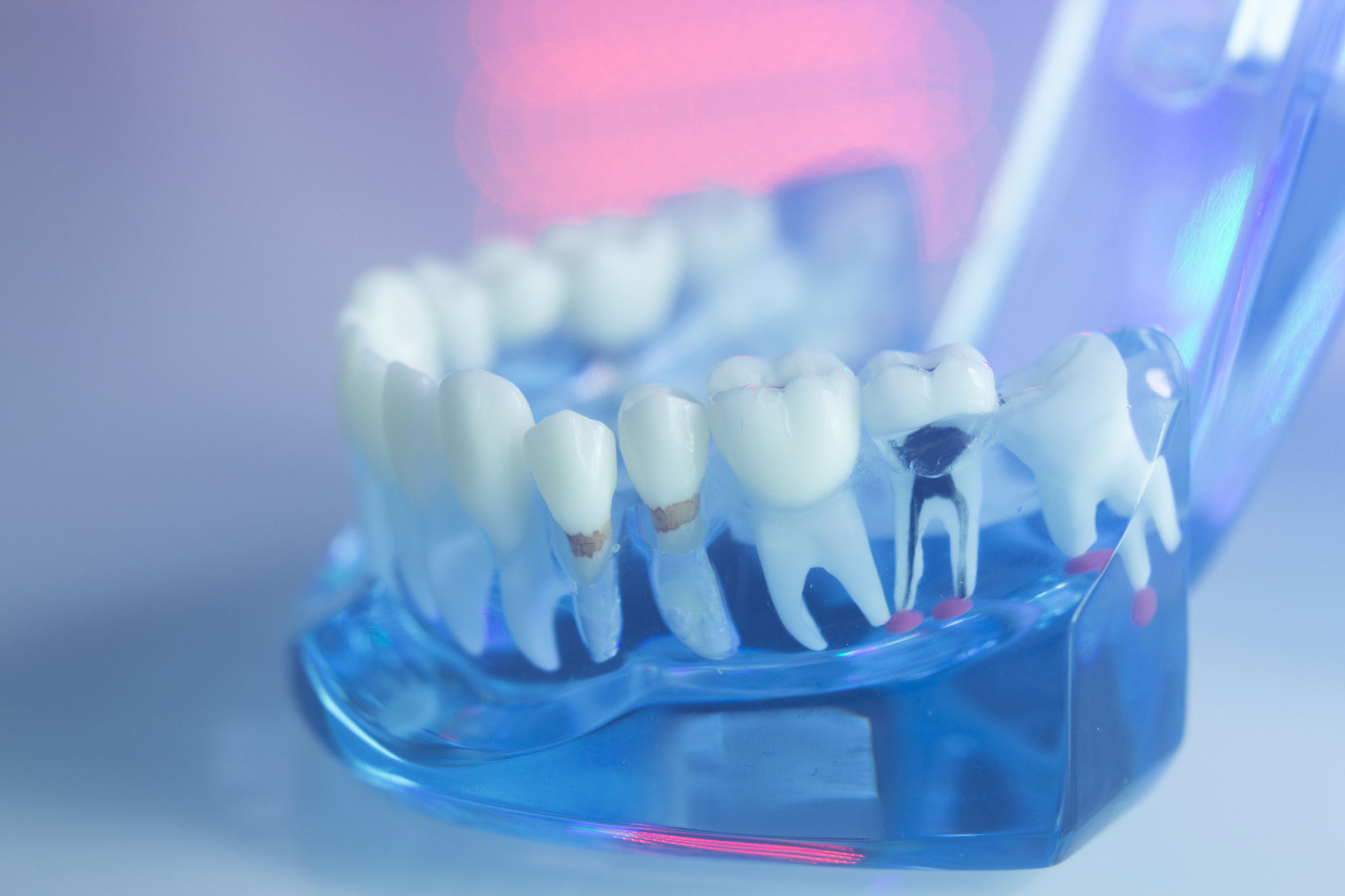 A translucent blue dental model showing root canal anatomy