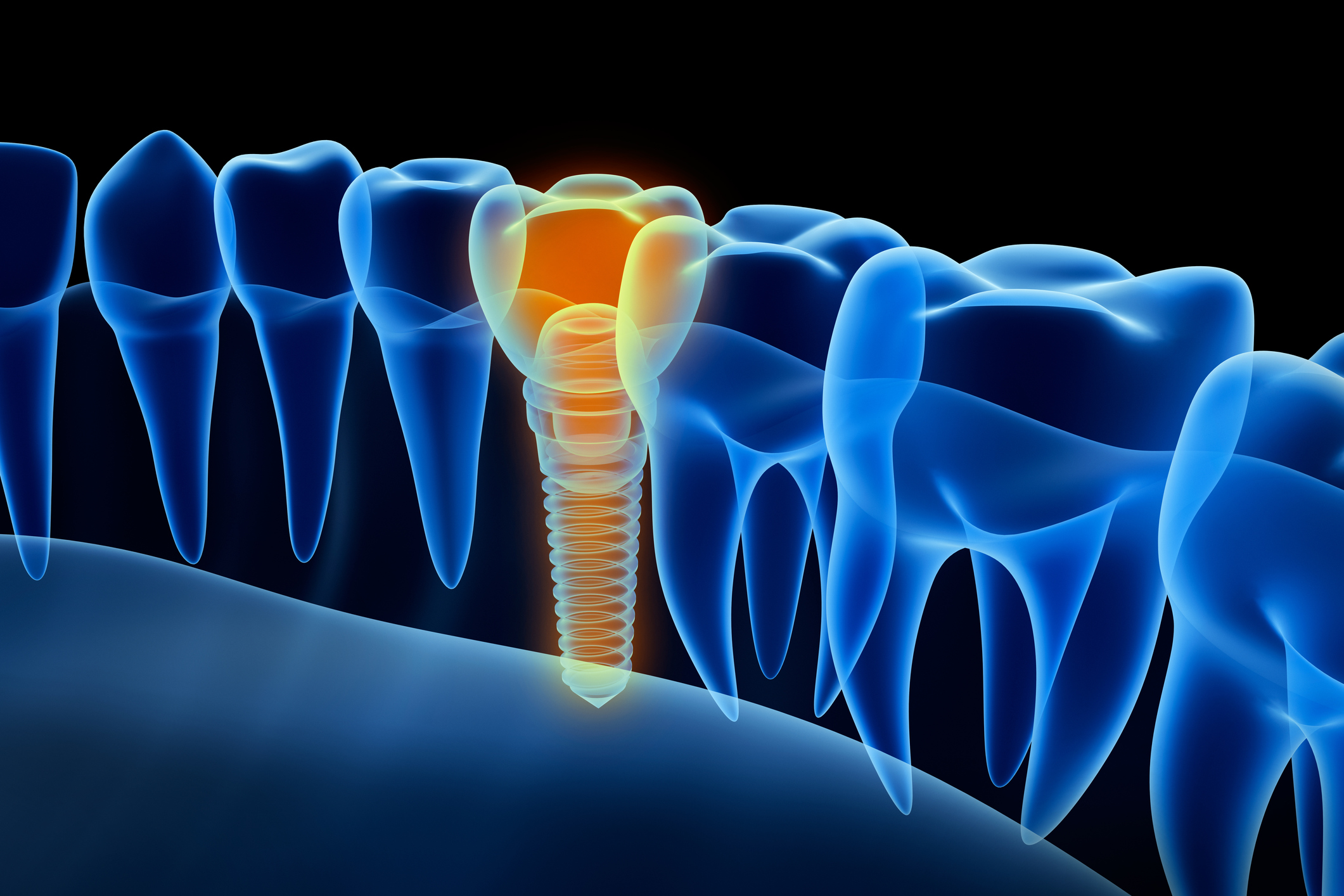 Dental implant restoration illustration