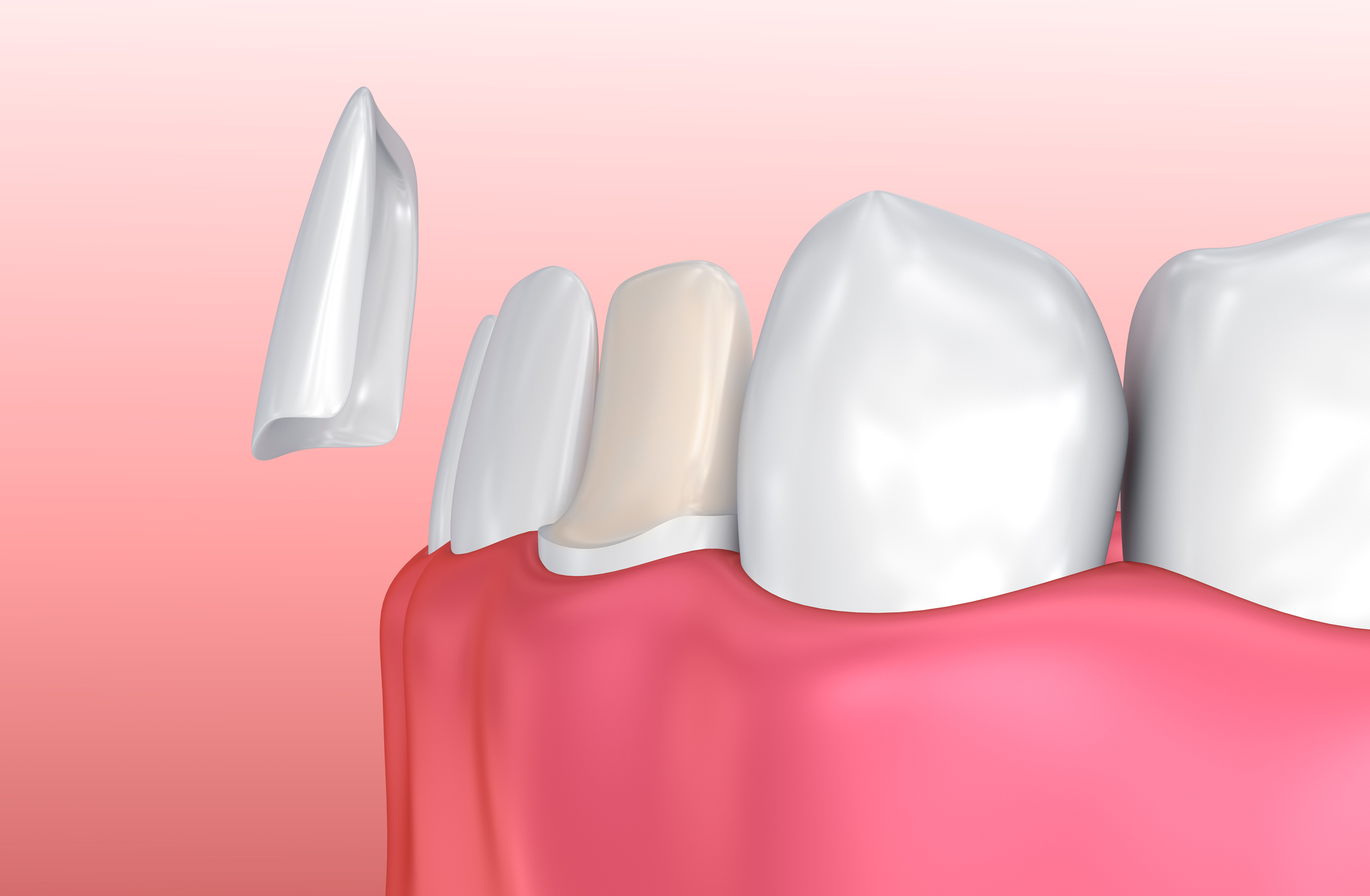Porcelain veneers treatment